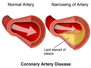 Coronary Artery Disease and Oxidative Stress