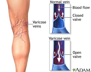Varicose Veins and Oxidative Stress